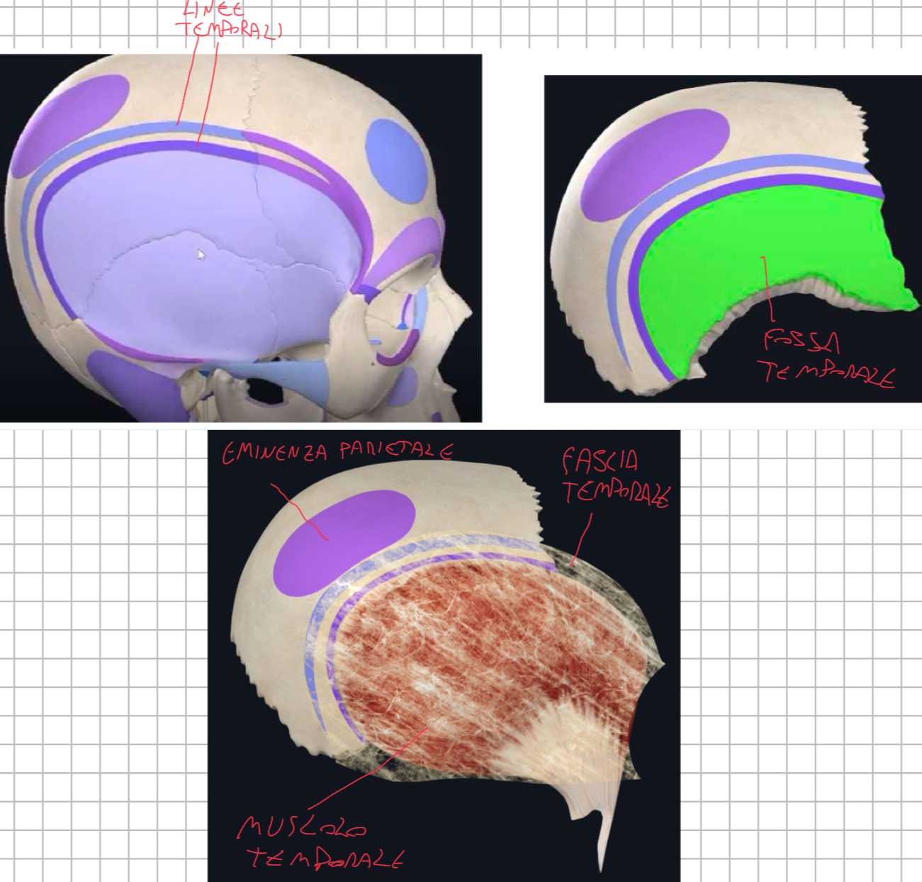 <p>Forma quadrilatera, pari e simmetrica:</p><ol><li><p>Presenta le due linee temporali che continuano dall’Osso Frontale:</p><ul><li><p>Quella superiore rappresenta la linea si inserzione della Fascia Temporale che ricopre il muscolo temporale</p></li><li><p>Quella inferiore delimita la Fossa Temporale dove origina il muscolo temporale</p></li></ul></li><li><p>Eminenza Parietale: punto più sporgente dell’osso corrispondente al centro di ossificazione primario</p></li></ol><p></p><p></p><p></p>