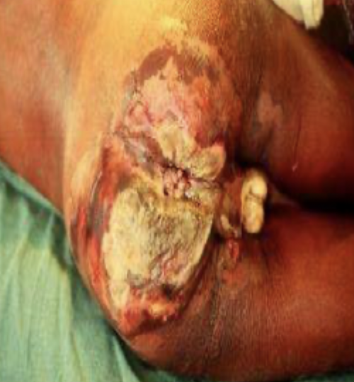 <p>Necrotizing anorectal infection risk factors</p>
