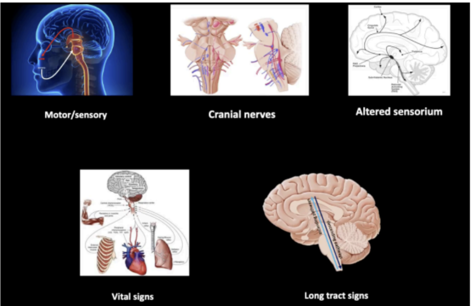 <ul><li><p>affectation of motor and sensory of the head</p></li><li><p>involvement of the cranial nerves</p></li><li><p>alteration of the sensorium</p></li><li><p>association with cardiorespiratory abnormalities</p></li><li><p>long tract signs</p></li></ul><p></p>