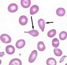 <p><span style="font-family: "Times New Roman", serif">Tear-shaped RBCs; seen in myelofibrosis, thalassemia, or marrow infiltration.</span></p>