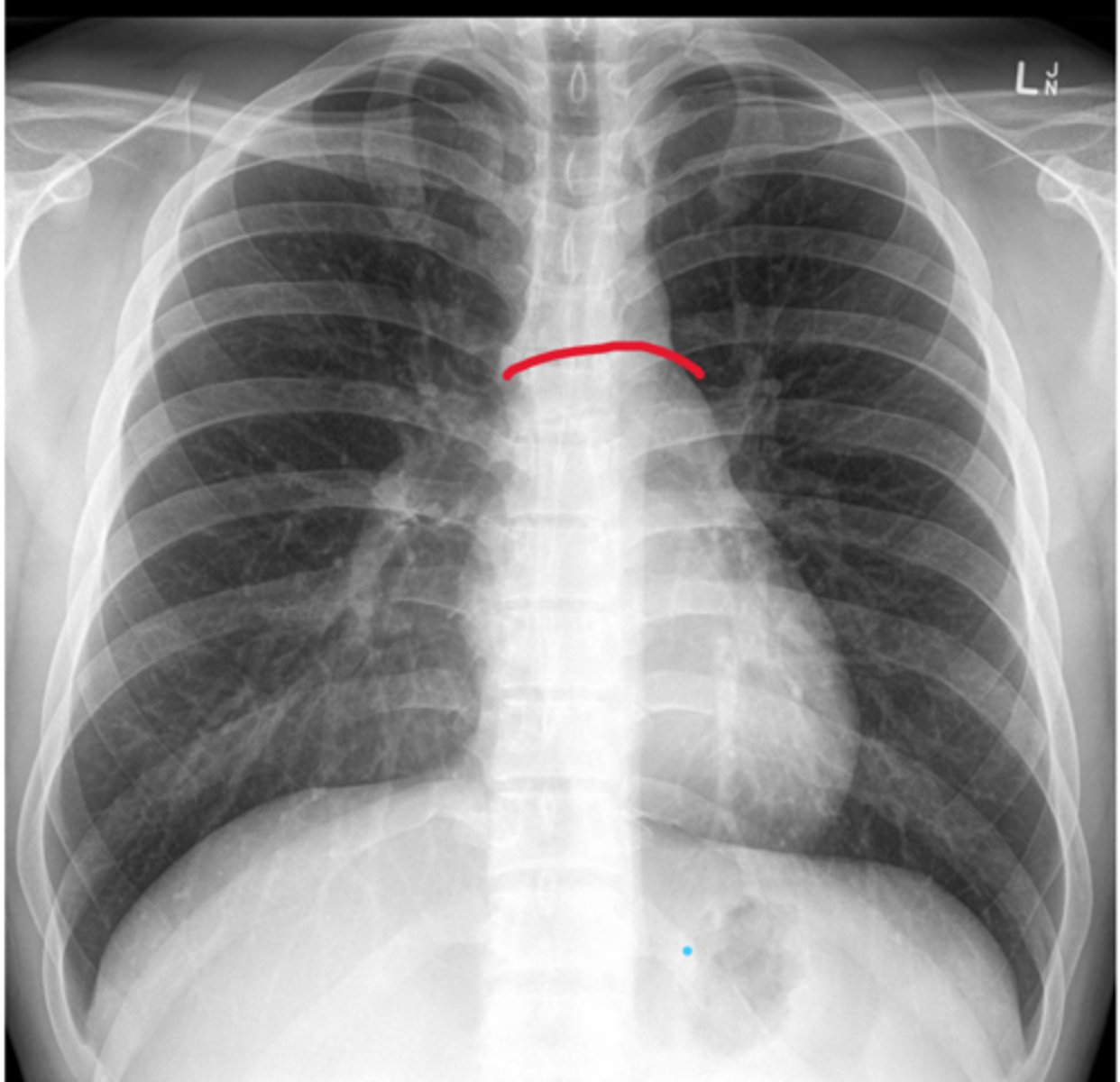 <p>Boundary; X-ray, top edge</p>