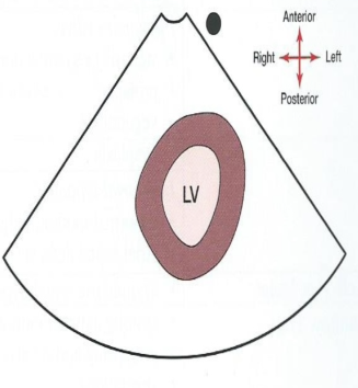 (Usually only LV apex but may also see RV apex)