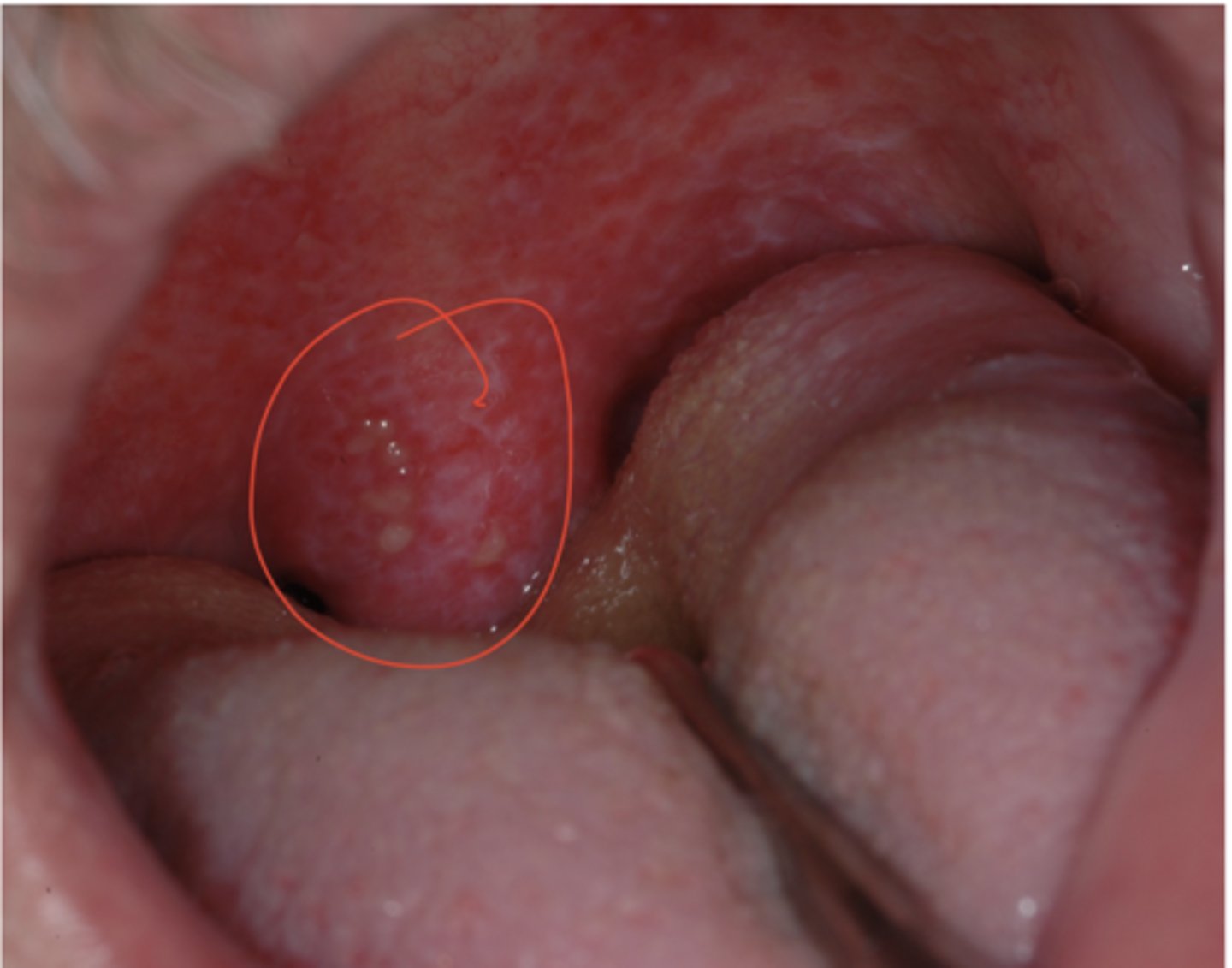 <p>Hint: Primary infection in adults - pharyngotonsillitis</p>