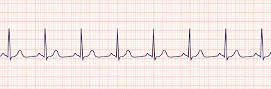 <p>What ECG trace is this</p>