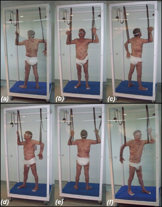 <p>TSI: Total Skin Irradiation to degrade a 6 MeV beam to 4 MeV</p>