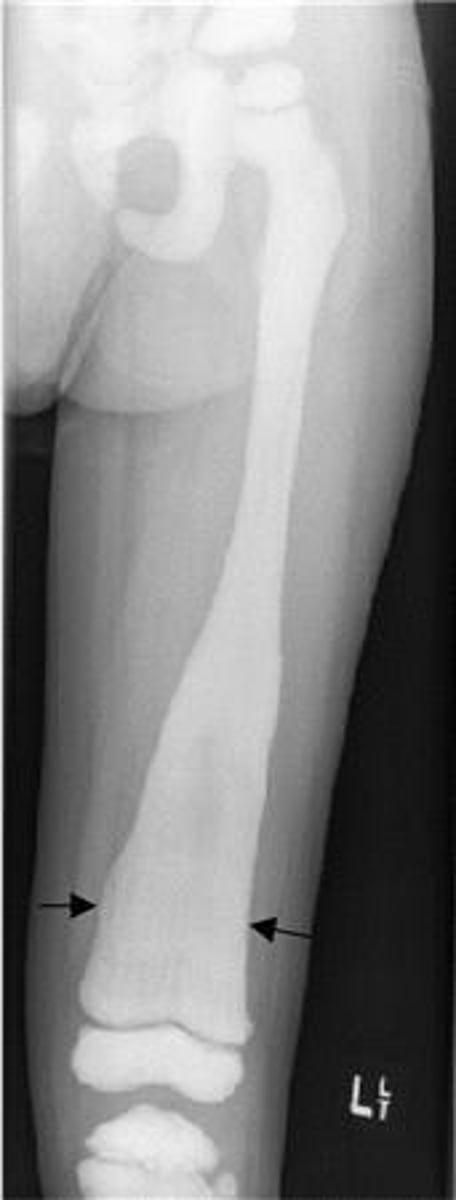 <p>erlenmeyer flask deformities of long bone</p>