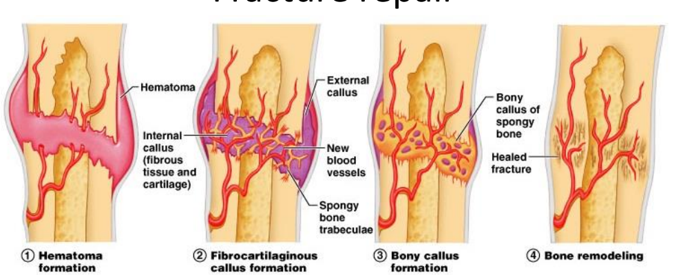 <ul><li><p>Hematoma formation: Blood leaks from broken blood vessels, leading to the formation of a hematoma (blood clot).</p></li><li><p>Fibrocartilaginous callus formation: A few days after the fracture, new blood vessels form across the hematoma, and fibrocartilage begins to form.</p></li><li><p>Bony callus formation: Around 1.5 weeks after the fracture, trabeculae of spongy bone begin to form, and the callus solidifies within two months.</p></li><li><p>Bone remodeling: Over the following months, compact bone is formed, and excess bone material is removed as the bone remodels along lines of stress.</p></li></ul><p></p>