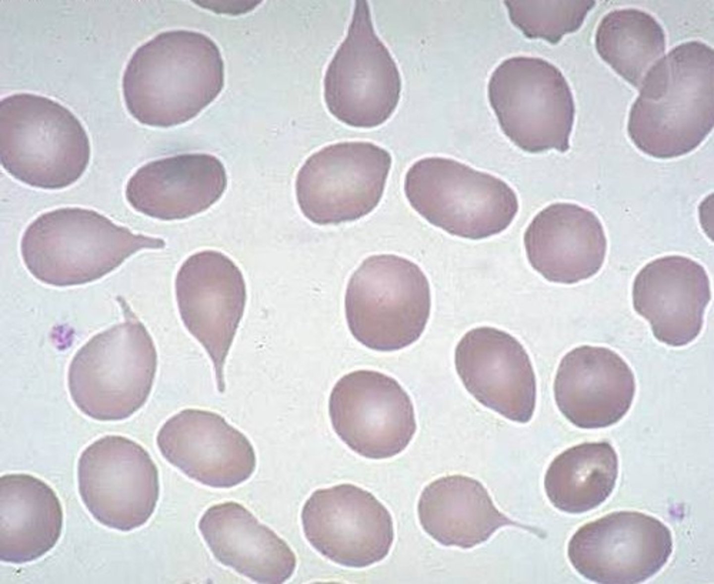 <p>Myelofibrosis (chronic blood cancer causing scarring in bone marrow)</p>