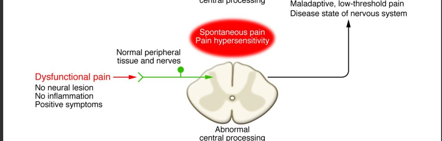 <p>no neural lesion, no inflammation, positive symptoms -&gt; normal peripheral tissue and nerves -&gt; abnormal central spinal processing -&gt; maladaptive, low-threshold pain disease state of nervous system</p>