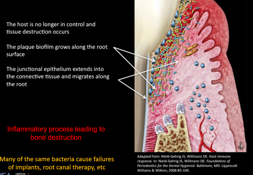 <ul><li><p>the host is no longer in control and tissue destruction occurs</p></li><li><p>the plaque biofilm flows along the root surface</p></li><li><p>the junctional epithelium extends into the connective tissue and migrates along the root</p></li></ul><p></p><ul><li><p>inflammatory process leading to bone destruction</p></li><li><p>Many of the same bacteria <u>cause failures of implants, root canal therapy</u>, etc</p></li></ul><p></p>