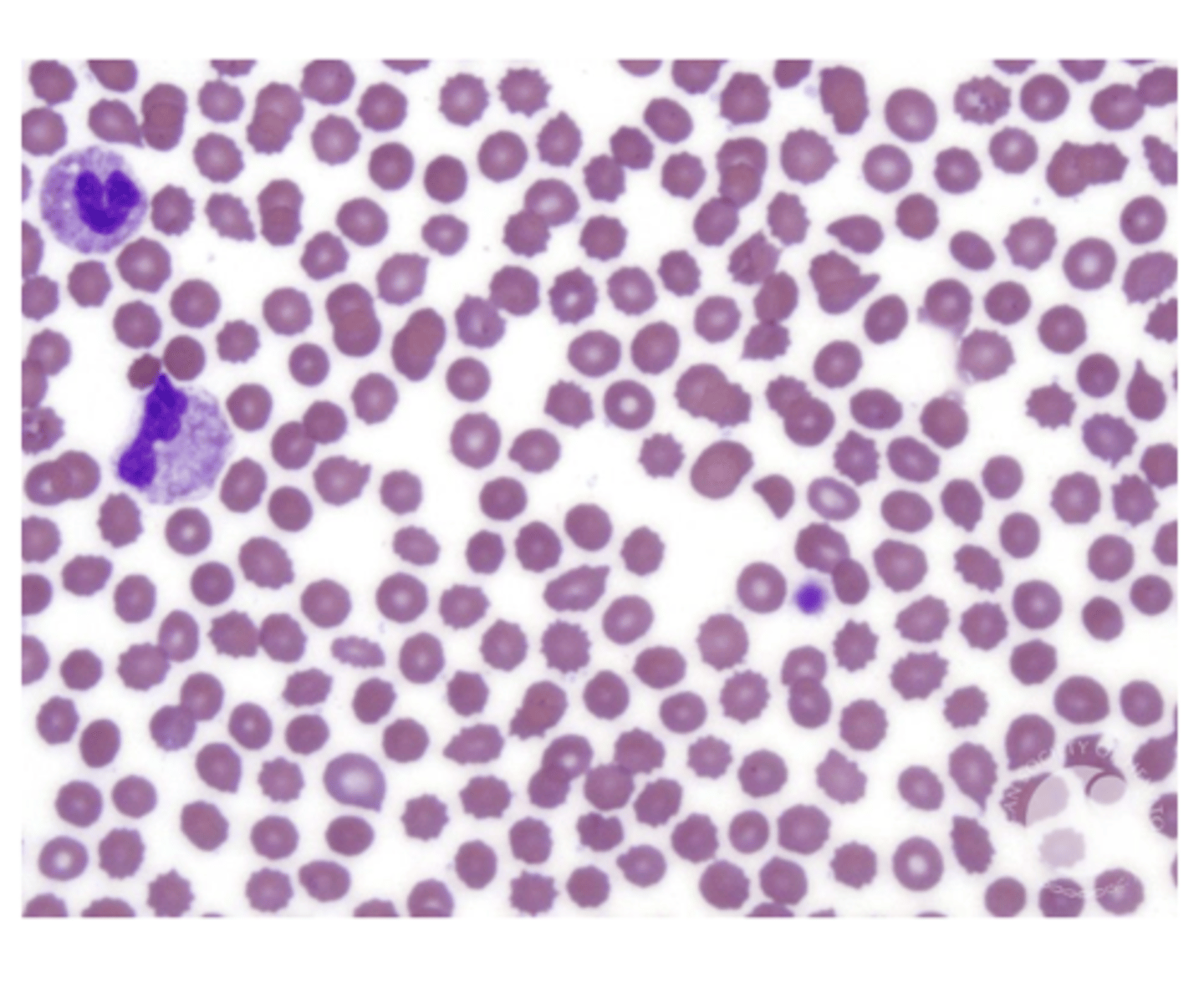 <p>CBC:</p><p>- anemia</p><p>- normo/normo</p><p>-PBS: echinocytes</p><p>UA:</p><p>- proteinuria</p><p>additional tests:</p><p>- kidney function test</p><p>- renal imaging studies</p><p>- nephrologist</p>