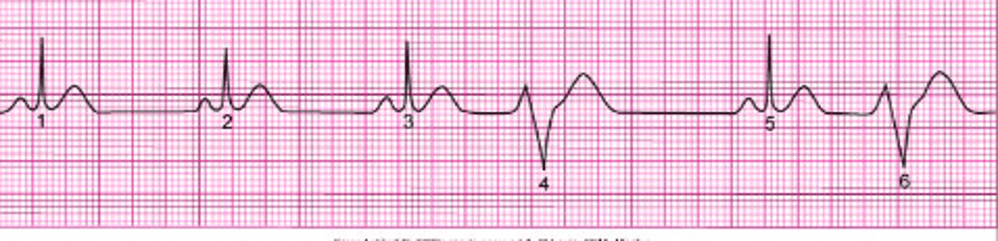 <p>this arrhythmia is caused by an ectopic focus arising from the ventricles below the Bundle of His, where the QRS (of the ectopic focus) is not preceded by a P-Wave</p>
