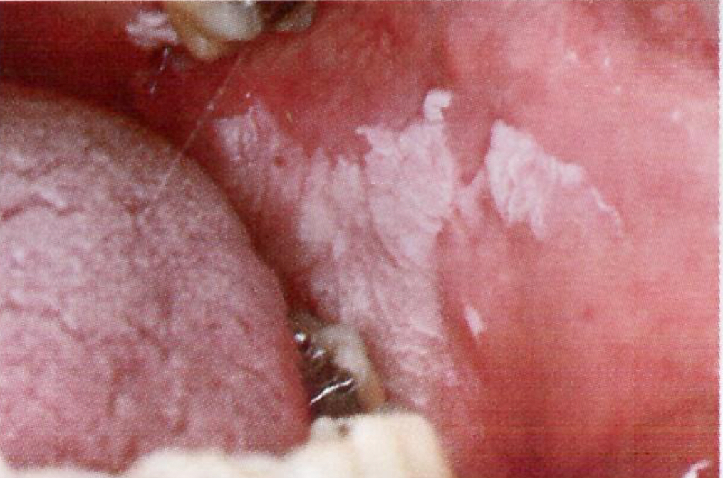 <p>Leukoplakia&nbsp;</p>