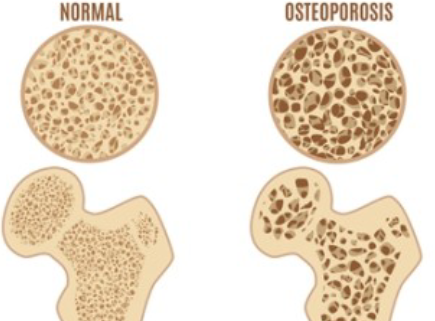 <p>Osteoporosis</p>