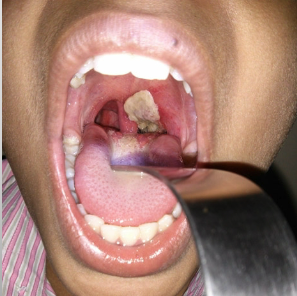<ul><li><p>pseudomembrane produced on<strong> soft palate + pharynx</strong></p></li><li><p><strong>fever</strong></p></li><li><p>malaise</p></li><li><p>sore throat</p></li><li><p>neck swelling </p></li></ul><p></p>