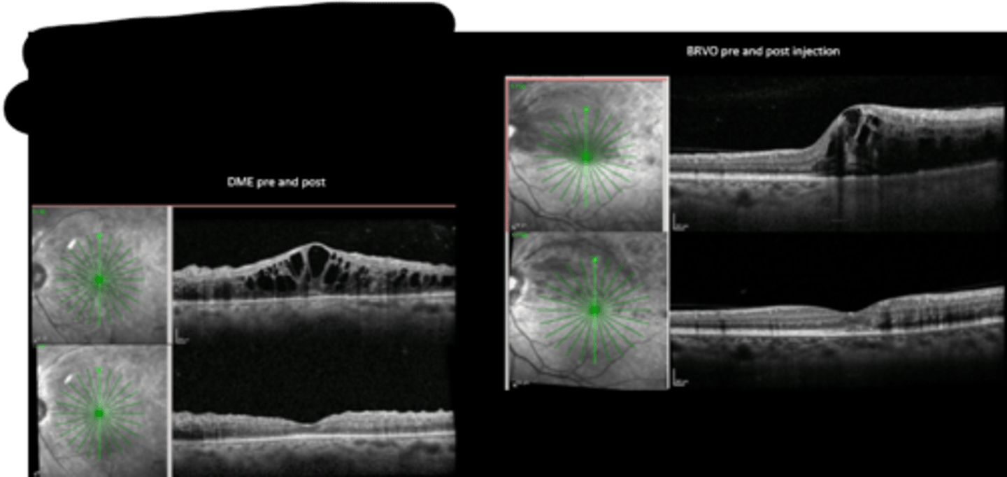 <p>What are some indications for using anti-VEGF?</p>