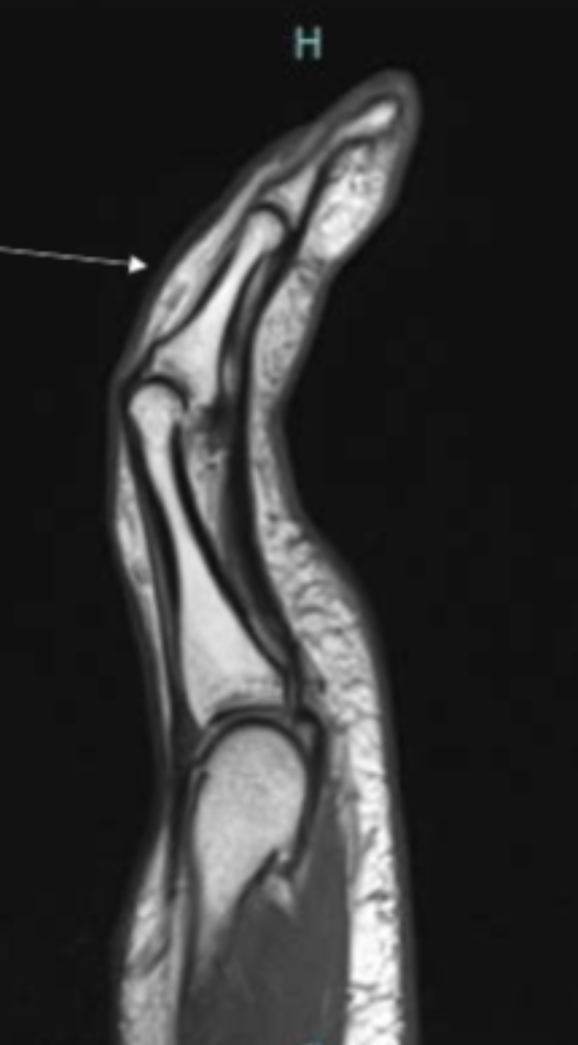 <p>Describe the pathology indicated by the arrow (Sag PD).</p>