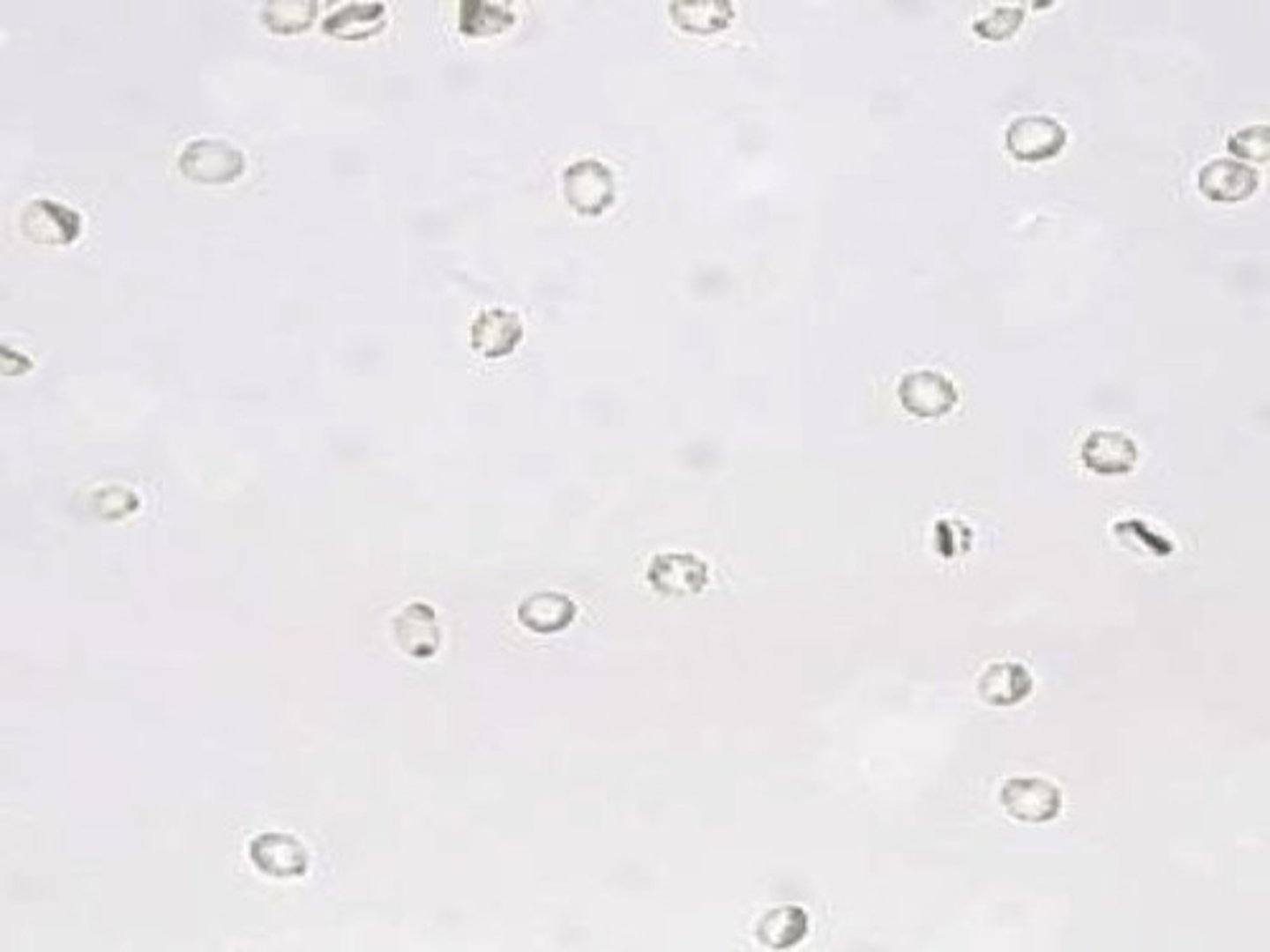 <p>Appear as smooth, non-nucleated, biconcave disks measuring approximately 7mm in diameter</p><p>- In concentrated urine they may appear CRENATED; or irregularly shaped</p><p>- In dilute urine, they may swell and burst leaving only the cell membrane behind, these are known as GHOST CELLS</p><p>- They also may just be dysmorphic in size, have cellular protrusions and are fragmented due to certain diseases</p><p>DO NOT: confuse with yeast cells (budding), oil droplets/air bubbles (which are refractile in the light)</p><p>Clinical Significance:</p><p>- Associated with damage to the glomerular membrane or vascular injury within the genitourinary tract</p><p>- Also can be seen following strenuous exercise and menstruation</p>