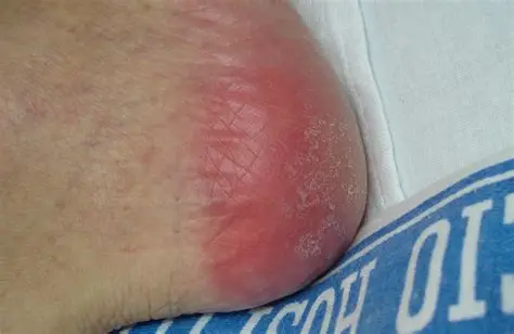 <p>Intact skin with non-blanchable redness</p>