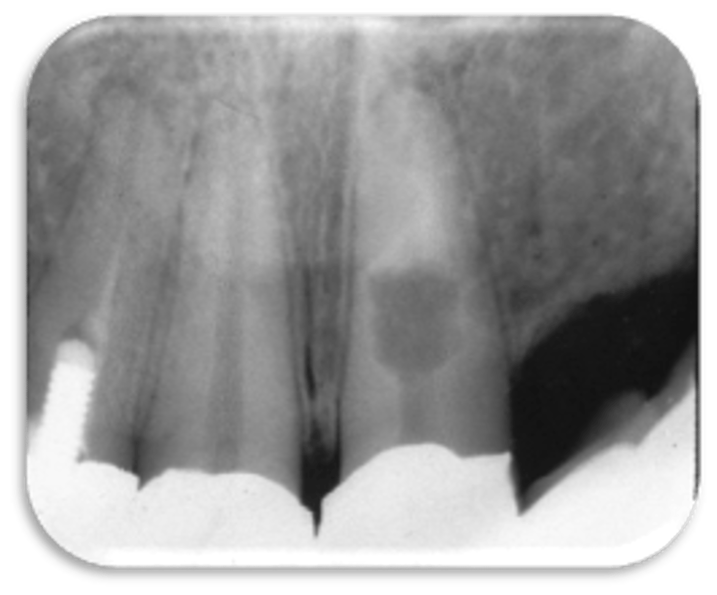 <p>ID the problem:</p><p>- Ballooning out of root canal</p>