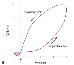 <ul><li><p><span>"Figure eight" type of loop is typical of patient effort</span></p></li><li><p><span>In this case the patient effort is triggering/initiating activity so the small loop lies in the lower left aspect of the tracing (shaded area)</span></p></li><li><p><span>Patient-ventilator dyssynchrony may result in small patient-generated loops at other points in the tracing (e.g. the expiratory limb)</span></p></li><li><p><span>The dashed vertical line and arrow indicate the PEEP value</span></p><ul><li><p><span>Note that the patient efforts bring airway pressure below this resting value</span></p></li></ul></li><li><p><span>Once the triggering threshold is reached, a machine-delivered breath proceeds</span></p></li><li><p><span>The size of the shaded area of the patient effort loop indicates the work done by the patient to trigger the breath</span></p></li></ul><p></p>