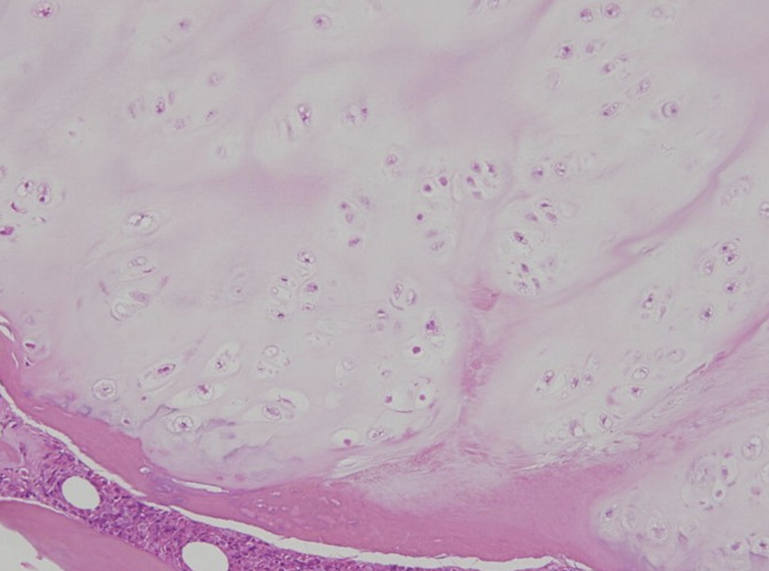 <p><span>Describe the gross appearance.</span></p><p style="text-align: left;"><span>What is the cell of origin?</span></p><p style="text-align: left;"><span>What is the diagnosis?</span></p><p style="text-align: left;"><span>What is the malignant counterpart called?</span></p>