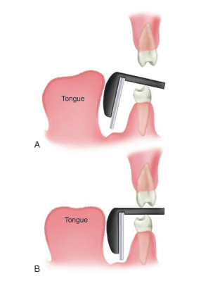 <ul><li><p>film is placed under the tongue to avoid impinging on muscle attachments </p></li><li><p>film is adjusted after the client closes down on the bite-block</p></li></ul><p></p>