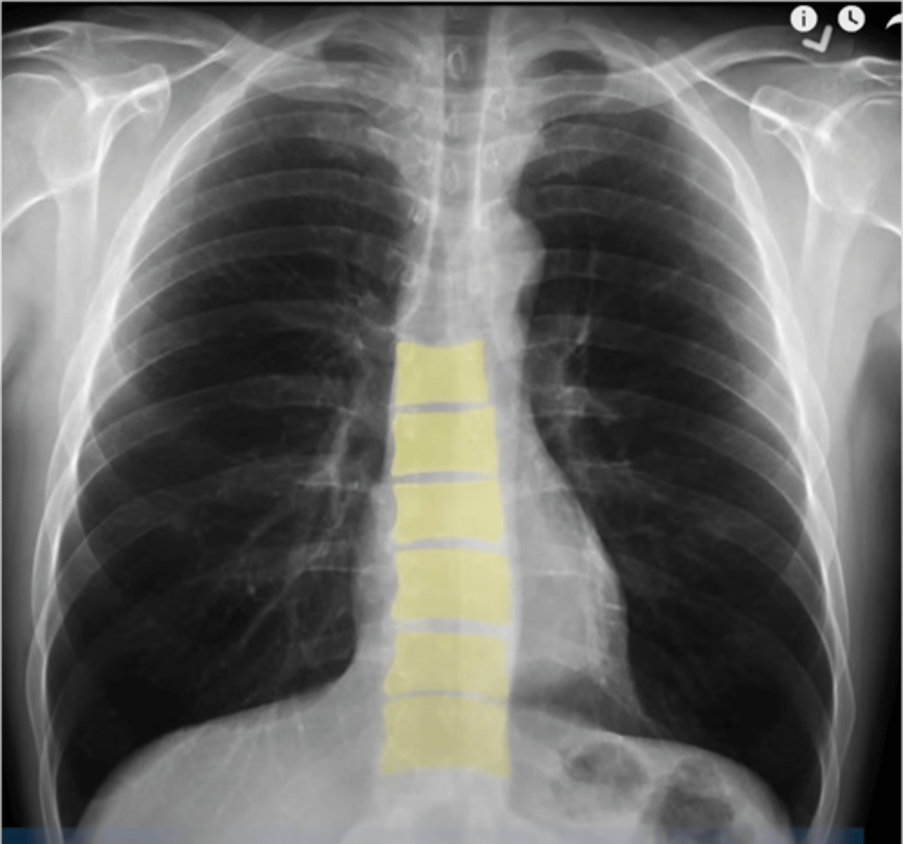 <p>-exposure: can the details be seen (ex. the vertebral bodies behind the heart)</p>