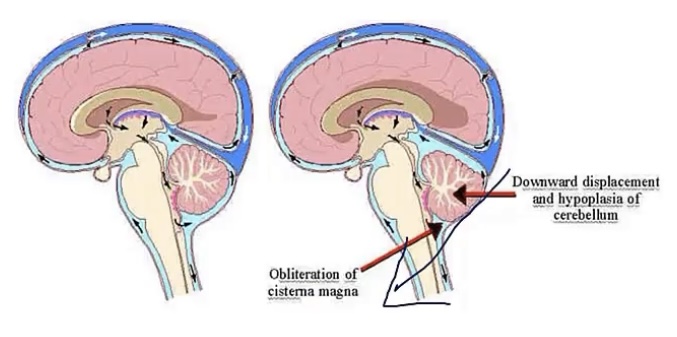 <p>-congenital</p><p>-downward displacement of cerebellum and medulla; outflow of the 4th ventricle into the spinal cord</p><p>-myelomeningocele/spina bifida(cord/meninges outside of the spine)</p><p>-non-communicating hydrocephalus</p>