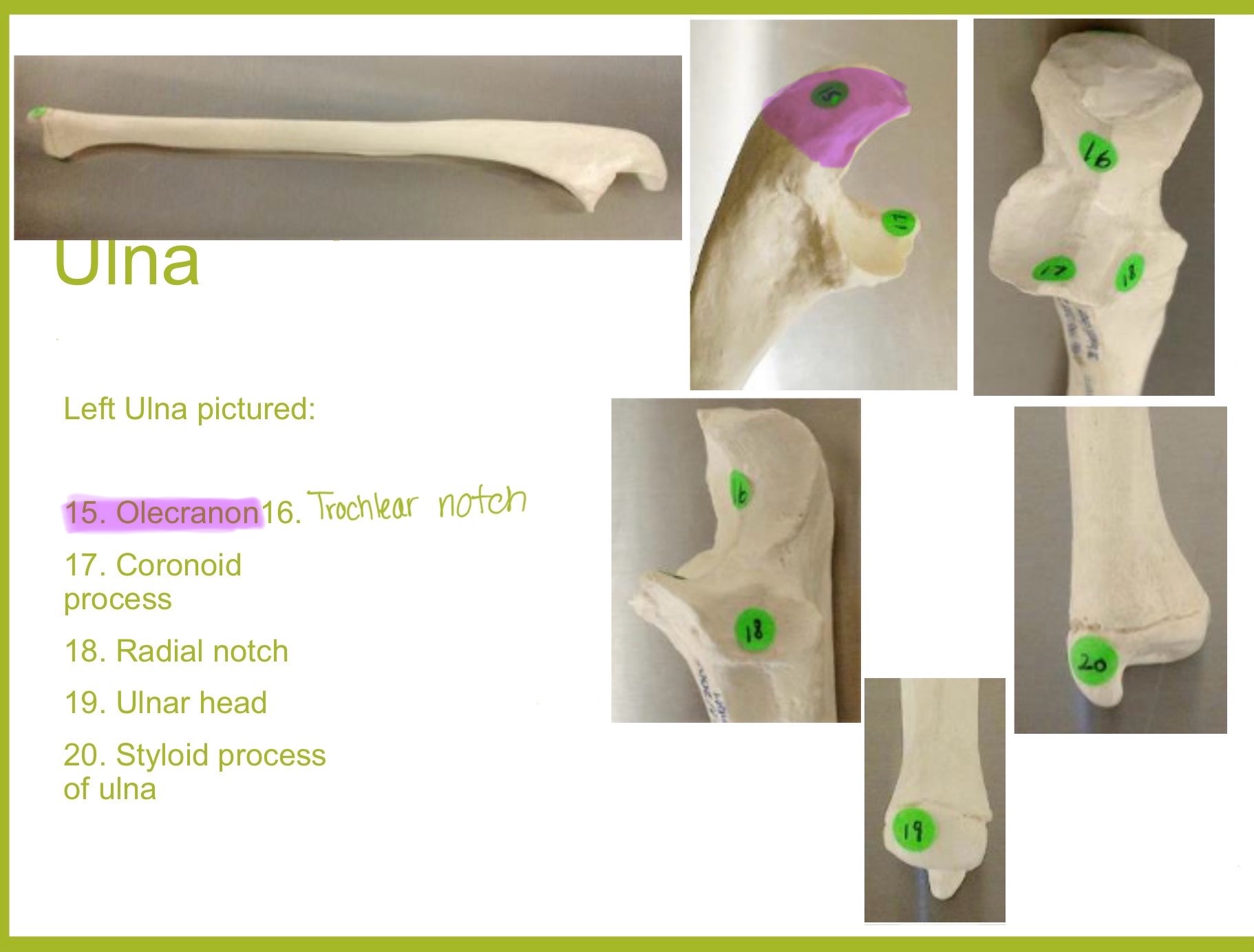 <p>olecranon process of ulna</p>