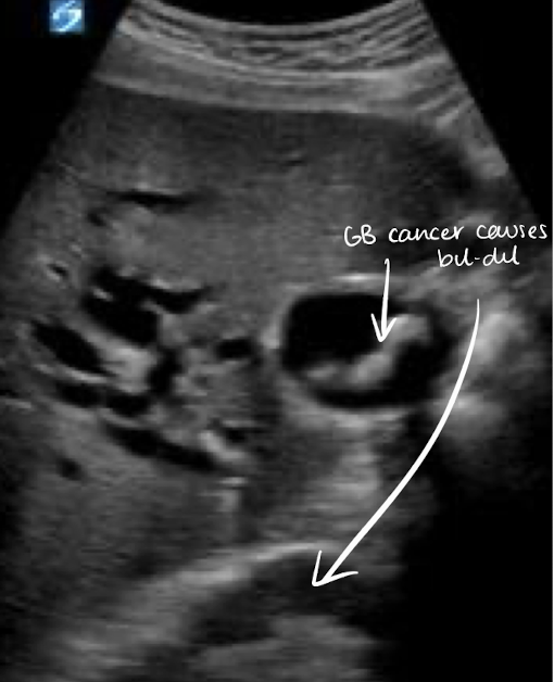 <p><mark data-color="yellow" style="background-color: yellow; color: inherit;">gallbladder carcinoma</mark></p><ul><li><p>GB mass —> “bil-dil”</p></li></ul><p></p>
