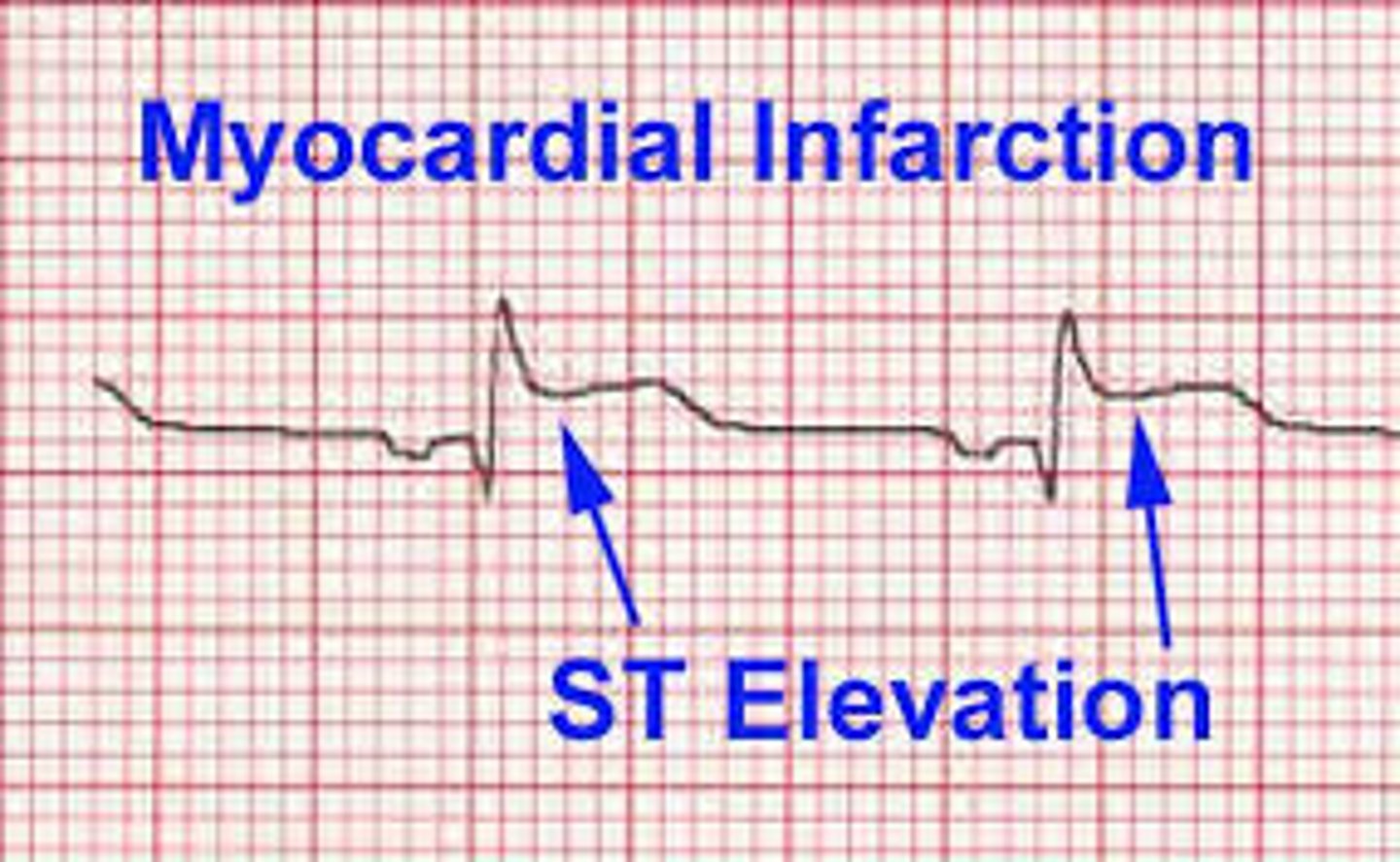 <p>what happens when there is no S or T wave</p>