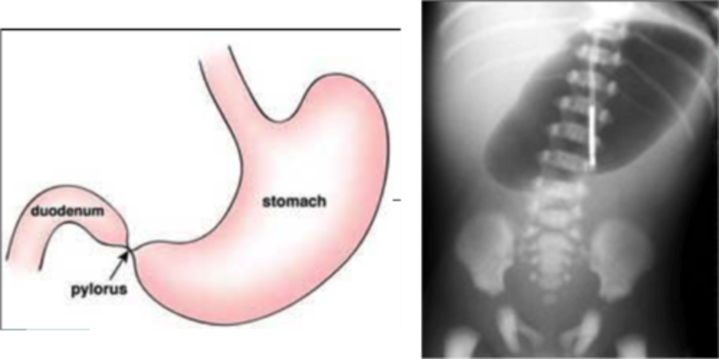 <p>a blockage (obstruction) of the lower part of the stomach (the pylorus)</p><p>- prevents food from emptying out of the stomach into the intestine </p><p>-s/s: vomiting, a swollen (distended) abdomen, absence of stool</p><p>tx: survery = gastroduodenostomy or gastrojejunostomy</p>