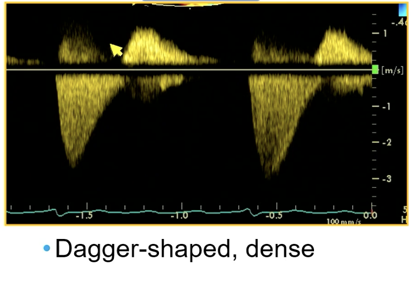 <p>CW through mitral showing</p>