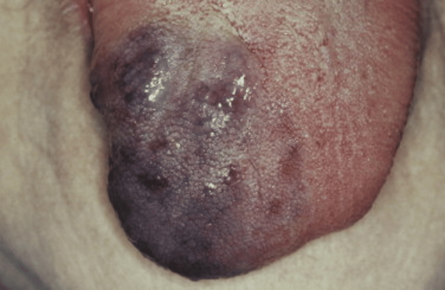 <p>______ ______ has most common sites in the head and neck (lips, tongue, buccal mucosa or palate), deep red or blue compressible lesions, lesions can be in the soft tissue or central (intraosseous) in location. It can undergo spontaneous remission remission butt can be treated with surgery, embolization, sclerosing agents, cryotherapy and laser</p>
