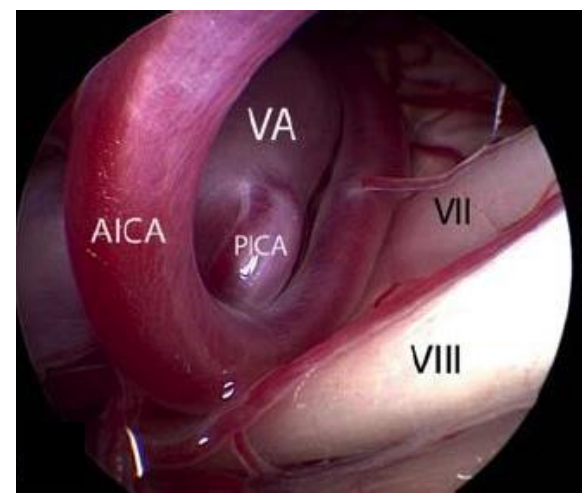 <ul><li><p>Neurovasculaire compressie van de n. VIII:</p><ul><li><p><strong><u>AICA  → meestal</u></strong></p></li><li><p><strong><u>PICA  → 2de meest</u></strong></p></li><li><p>Arteria labyrinthis </p></li><li><p>Veneus bloedvat </p></li><li><p>Tumor </p></li><li><p>Cyste </p></li><li><p>Trauma </p></li></ul></li><li><p>Dit zorgt voor </p><ul><li><p> Zenuwbeschadiging t.g.v. compressie en demyelinisatie </p></li><li><p>En <strong><u>ephaptische transmissie (laterale transmissie)</u></strong> = door demyelinisatie gaan signalen ook op andere neuronen verder lopen = paroxysmale interaxonaletransmissie (vergelijk met elektriciteit kabel zonder isolatielaag)</p></li></ul></li></ul><p>(OPGELET: veel mensen hebben een bloedvat dat op de zenuw ligt → zorgt niet altijd voor klachten)</p>
