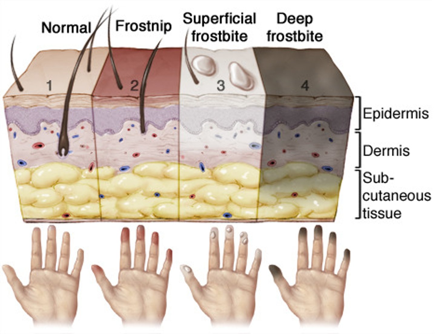 <p>what degree of frostbite is this describing?</p><p>partial thickness skin freezing</p><p>erythema, edema and LACK of blistering</p>