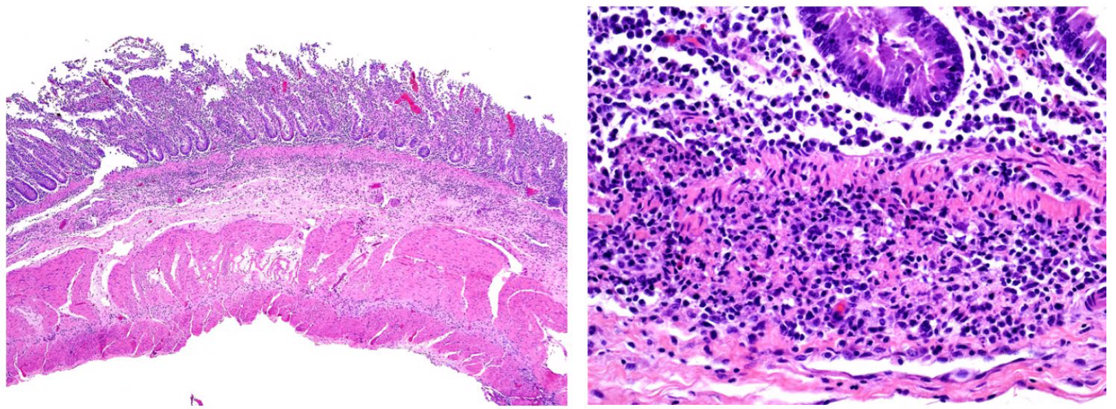 <p>What is the etiology?</p><p>A-Listeria monocytogenes</p><p>B-Salmonella Typhimurium</p><p>C-Yersinia pseudotuberculosis</p><p>D-Escherichia coli</p>