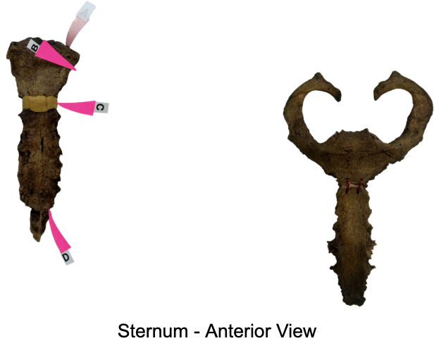 <p>Identify which landmark of the sternum: This facets on either side of the Angle of Louis afford articulation of 2nd Rib's Costal Cartilage</p><p>A. The “Angle of Louis”</p><p>B. The “Xiphisternal Joint”</p><p>C. The “Tip of the Xiphoid Process”</p><p>D. The Groove for “Sternal End of the Clavicle”</p><p>E. The “Suprajugular Notch”</p>