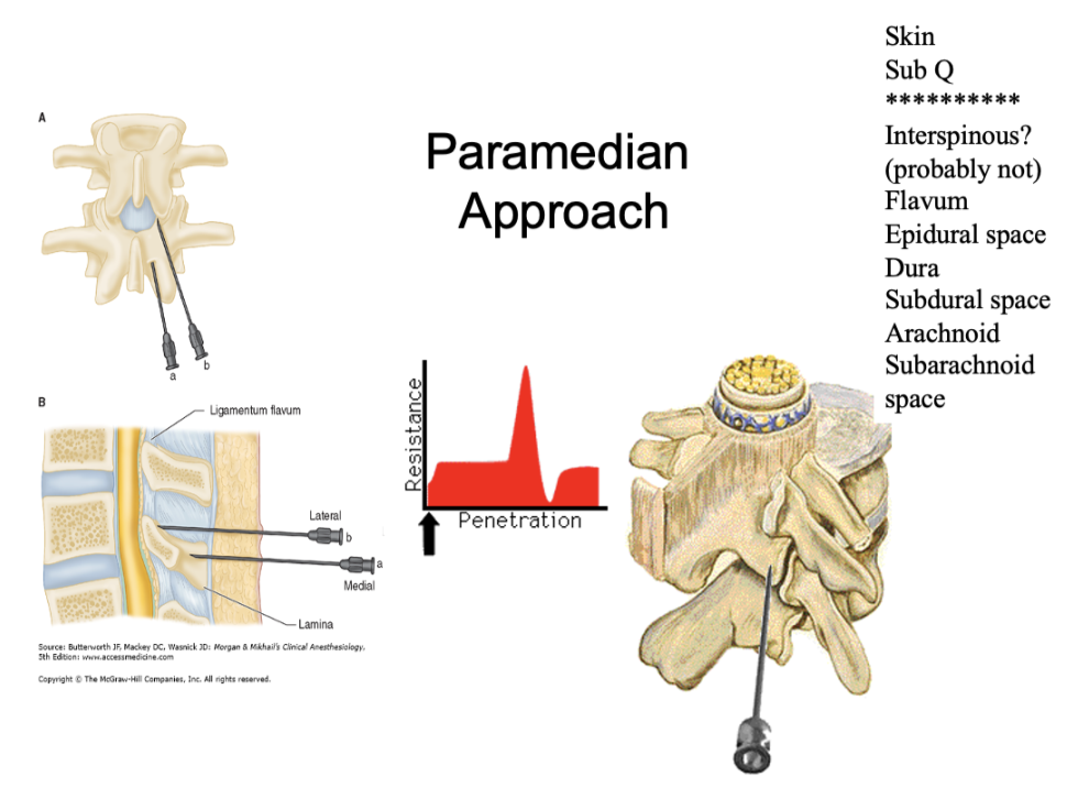 <ul><li><p>skin</p></li><li><p>sub Q</p></li><li><p>interspinous??? maybe, but probably not</p></li><li><p>flavum</p></li><li><p>epidural space</p></li><li><p>dura</p></li><li><p>subdural</p></li><li><p>arachnoid</p></li><li><p>subarachnoid</p></li></ul>