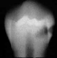 <p>caries classification?</p>
