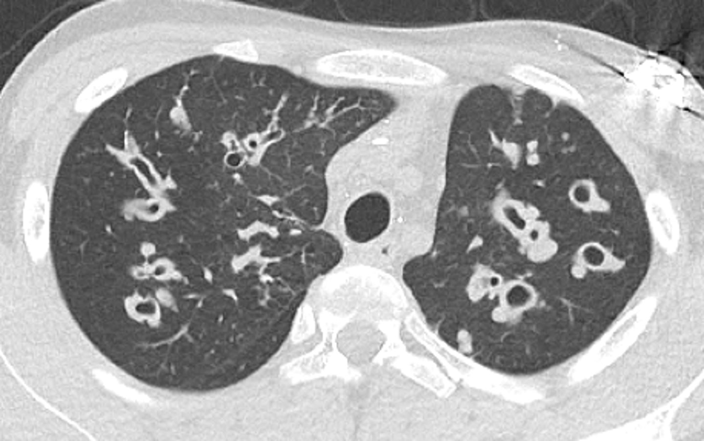 <p>cystic fibrosis</p>