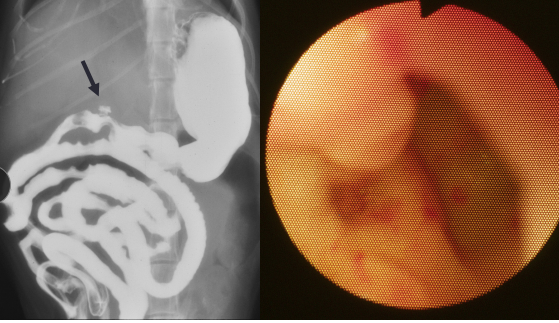 <ul><li><p><span style="background-color: transparent;"><strong><span>Et: </span><u><span>NSAID, Steroid,</span></u><span> GDV, MCT, renal dz, hepatic dz, sepsis</span></strong></span></p><ul><li><p><span style="background-color: transparent; color: green;"><span>NSAIDs block PG synthesis → ↓ mucus, bicarb, blood flow → mucosal erosion</span></span></p></li><li><p><span style="background-color: transparent; color: green;"><span>NSAID + steroid = ulcer</span></span></p></li></ul></li><li><p><span style="background-color: transparent;"><strong><span>Cs: </span></strong></span><span style="background-color: transparent; color: red;"><strong><u><span>Hematemesis, melena, anemia, pale MM</span></u></strong></span></p></li><li><p><span style="background-color: transparent;"><strong><span>Dt: </span></strong><u><span>Endoscopy (#1)</span></u><strong><span>,</span></strong><span> regen/ iron-deficiency anemia, ↓ protein, thick mucosa</span></span></p><ul><li><p><span style="background-color: transparent;"><span>Determine GI or systemic</span></span></p></li></ul></li><li><p><span style="background-color: transparent;"><strong><span>Tx: </span></strong><span>Fluids, (PPI) Omeprazole, Sucralfate</span></span></p></li></ul><p></p>