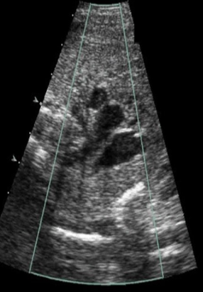 <p>the 3 vessel view of the fetal heart shows all <strong>except</strong></p><p>a) inferior vena cava</p><p>b) superior vena cava</p><p>c) pulmonary artery</p><p>d) AO</p>