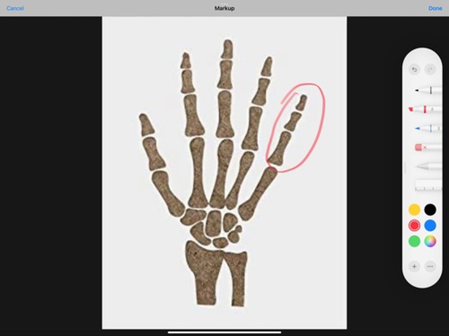 <p>fifth digit of the hand, fifth finger, or little finger.... the medial most finger</p>