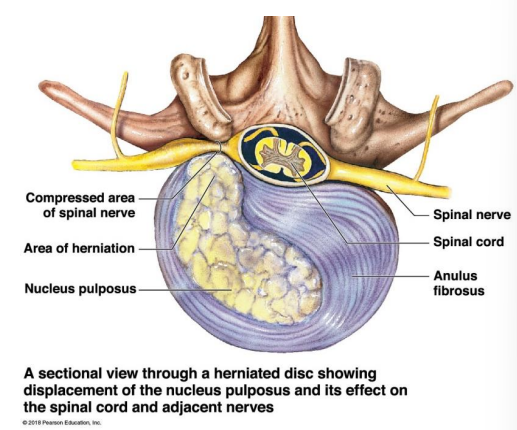 <p>Sectional view through a herniated disc showing displacement of the nucleus pulposus and its effect on the spinal cord and adjacent nerves</p>