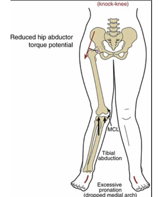 <ul><li><p>ACL stress</p></li><li><p>MCL &amp; medial capsule stress</p></li><li><p>patellar mal-tracking</p></li><li><p>lateral compartment osteoarthritis (OA)</p></li><li><p>possible knee replacement surgery</p></li></ul><p></p>