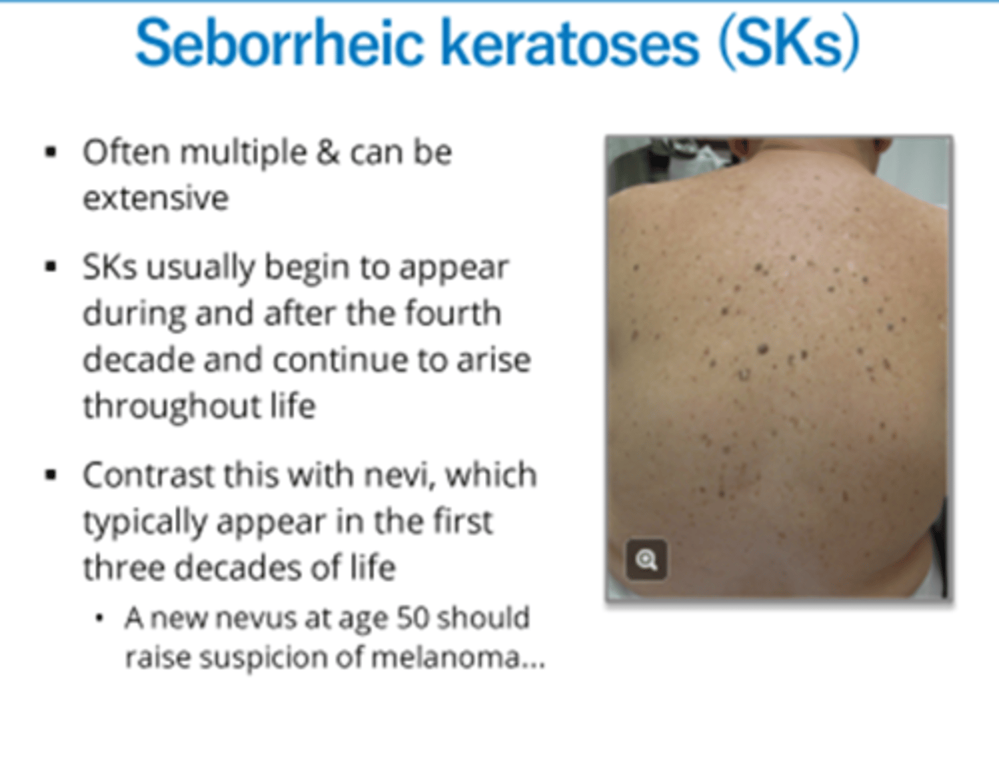 <p>When do seborrheic keratoses appear?</p>