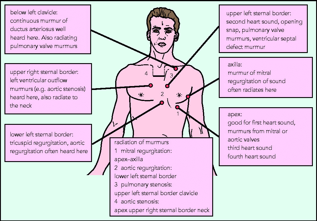 <ul><li><p><span style="font-size: inherit; font-family: inherit"><strong>With the patient supine at 45°</strong></span></p><ul><li><p>Listen with the <strong>bell</strong> over the mitral area [for mitral stenosis, S3 or S4]</p></li><li><p>Palpate the carotid pulse simultaneously to identify S1 and S2</p></li></ul></li><li><p><span style="font-size: inherit; font-family: inherit"><strong>Ask the patient to roll to the left</strong></span></p><ul><li><p>mitral area [for mitral stenosis, S3 or S4]</p></li></ul></li><li><p><span style="font-size: inherit; font-family: inherit"><strong>Ask the patient to return to supine at 45°</strong></span></p><ul><li><p>Change to the <strong>diaphragm</strong></p></li><li><p>mitral area [<em>for mitral regurgitation</em>]</p></li><li><p>in the axilla [<em>for the radiation of mitral regurgitation</em>]</p></li><li><p>tricuspid area<strong>&nbsp;</strong>[<em>for any tricuspid murmurs</em>]</p></li><li><p>Left sternal edge to the pulmonary area<strong>&nbsp;</strong>[<em>for any aortic murmurs</em>]</p></li><li><p>Pulmonary area [<em>for any pulmonary murmurs</em>]</p></li><li><p>Aortic area [<em>for any aortic murmurs</em>]</p></li><li><p>Change to the <strong>bell</strong></p></li><li><p>Listen over both carotids [<em>for radiation of aortic stenosis and for carotid bruit</em>]</p></li></ul></li><li><p><span style="font-size: inherit; font-family: inherit"><strong>Ask the patient to hold their breath</strong></span></p><ul><li><p>Listen over both carotids [<em>radiation of aortic stenosis (bilateral) or carotid bruit (unilateral or bilateral)</em>]</p></li></ul></li><li><p><span style="font-size: inherit; font-family: inherit"><strong><em>Dynamic manoeuvres - Leaning Forward &amp; Inspiration/Expiration</em></strong></span></p></li><li><p><span style="font-size: inherit; font-family: inherit"><strong><em>Dynamic manoeuvres - Valsalva manoeuvre</em></strong></span></p></li></ul><p></p>