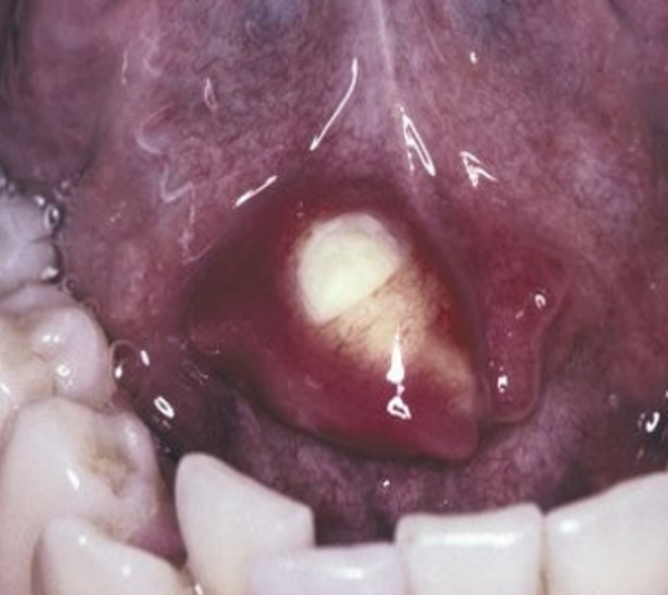 <p>Submandibular gland/duct</p>